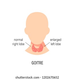 Goiter disease concept. Vector medical illustration of healthy and enlarged thyroid in flat style