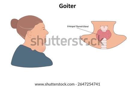  Goiter (Enlarged thyroid gland) vector illustration