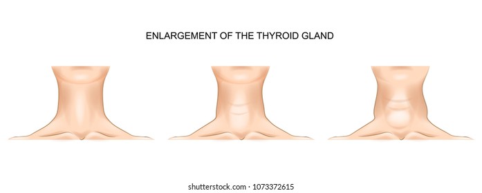 Goiter, Thyroid Gland