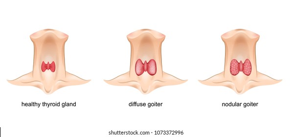 Goiter, Thyroid Gland