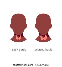 Goitre Disease Concept Vector Medical Illustration Stock Vector ...