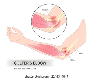 Golfer's elbow pain sport injury in pronation wrist common radial flexion rotator cuff of Cozen's with Mill's test nerve and Tricep extensor carpi radialis brevis muscle rupture