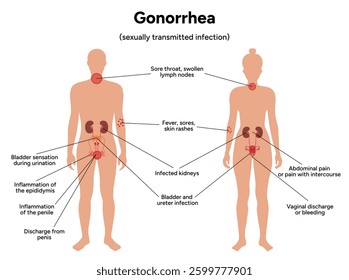 Gonorrhea. Human reproductive system transmitted infection virus bacterial. Medical diagram symptoms 