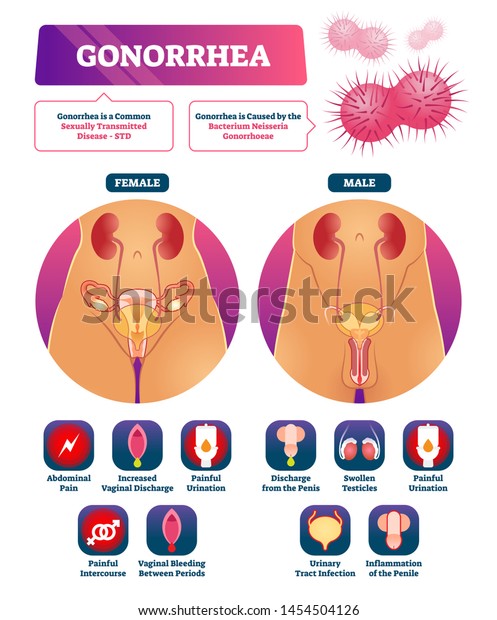 Gonorrhea vector illustration. Labeled STD\
disease explanation symptom list. Educational sexual transmitted\
bacteria caused illness infographic. Internal vaginal and penile\
infection diagnosis\
diagram