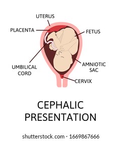Good baby positions in the uterus during pregnancy. Cephalic lies. Colored medical vector illustration. Fetus with umbilical cord and placenta.
