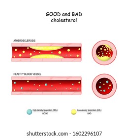 good (HDL) and bad (LDL) cholesterol. Healthy blood vessel and Atherosclerosis. Cross section of blood vessel. Low-density and High-density lipoproteins. Vector diagram