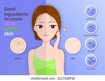 Good ingredients for acne prone skin