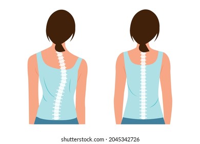 Good posture and bad posture. Chiropractic before after image. Scoliosis.Woman's body and backbone.
