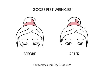 Goose feet wrinkles, laser cosmetology before procedure and after applying treatment line icon in vector. Illustration of a woman with smooth clean skin and problematic skin.