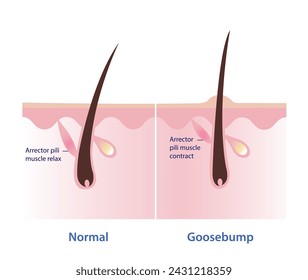 Goosebumps on the skin vector illustration isolated on white background. Comparison of normal skin, arrector pili muscle relax and goosebumps, arrector pili muscle contract, pull the hair straight up.