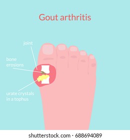 Gout arthritis. Human foot. Vector medical illustration.