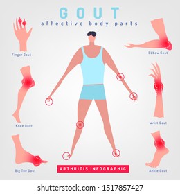 Gout arthritis infographic. Joint pain in human body. Editable vector illustration in bright colors isolated on white background. Modern flat style. Graphic design. Medicine, healthy lifestyle concept