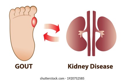 Gout can cause the kidney disease and vise versa.