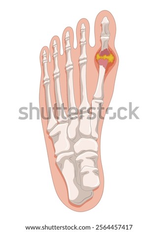 Gout diagram in human foot with crystallization of uric acid joint. Medical educational poster infographic scheme with inflammatory arthritis. Orthopedic disease vector illustration
