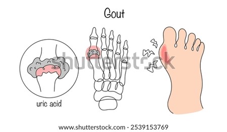 Gout. A disease of joints and tissues caused by metabolic disorders in the body. Deposition of uric acid in the joints of the foot. Medical vector for different uses. 