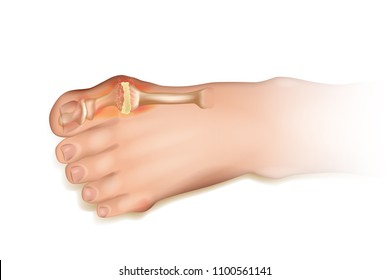 Gout.  Human Foot Illustration