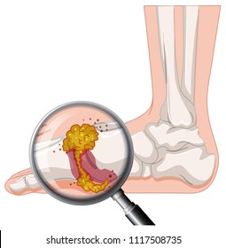 Gout In Human Foot illustration
