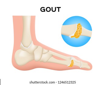 gout in human foot vector / human, anatomy