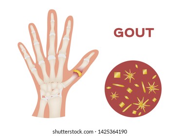 Gout In Human Hand Vector / Human, Anatomy