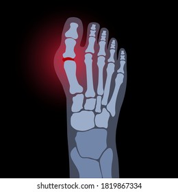 Gout illness logo for clinic. Arthritis joint in the ankle. Foot pain icon. Human feet bone anatomy flat vector illustration. Skeleton x ray scan concept. Painful injury and erosion. Medical poster.