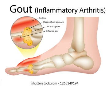 Gout (Inflammatory arthritis) Gout is an intensely painful type of arthritis , Illustration - Vector