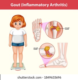 Gout (Inflammatory Arthritis) Medical Information Illustration