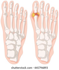 Diagram Showing Gout Toe Illustration Stock Vector (Royalty Free ...