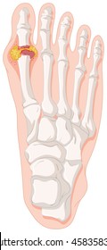 Gout Toe In Human Foot Illustration