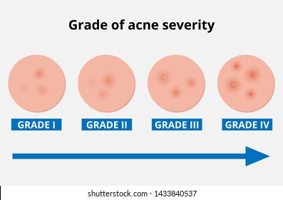 Acne Severity Chart