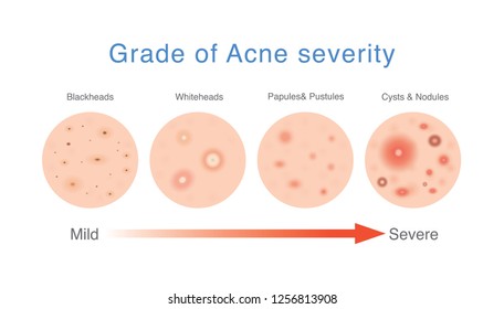 Acne Severity Chart