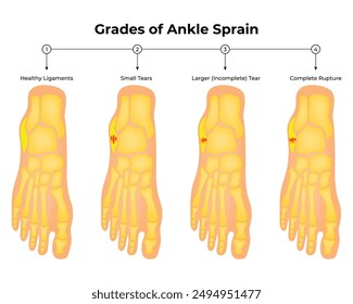 Grades of Ankle Sprin Science Design Vector Illustration Diagram