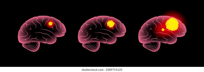 Grades of brain tumours. Cancer, metastasis or benign in the human head with different size and location. Oncology center medical poster. Growth of neoplasm in a human skull ct or mri scan vector