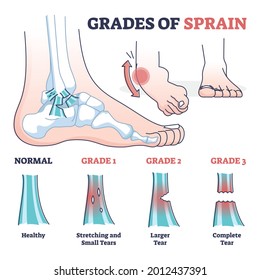 Grades of sprain as ankle or foot medical injury levels outline diagram. Anatomical leg problem significance measurement and division vector illustration. Healthy, stretching and tears explanation.