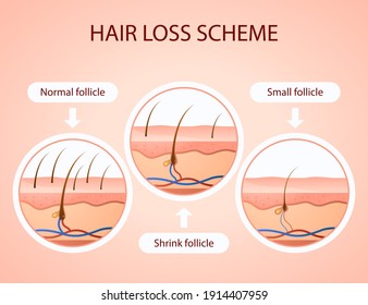 Gradient hair loss scheme Vector illustration 