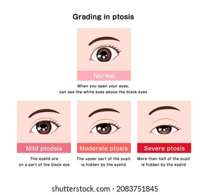 Grading In Ptosis Vector Illustration