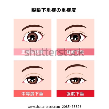 Grading in ptosis vector illustration. Translation: Normal, Mild ptosis, Moderate ptosis, Severe ptosis.