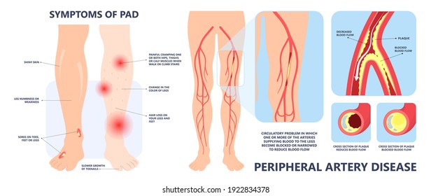 Symptome der Atherosklerose Cholesterin-Plaque in den Beinen Blutgefäß