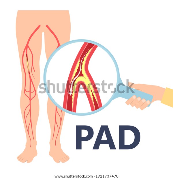 Graft artery PAD flow\
legs pain fatty treat hips Calf toes feet High heart ABI foot test\
Ankle clot injury arms stent veins Sores index attack venous ulcers\
blood limbs