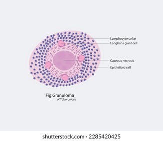 Granulom Tuberkulose AKA: Harte Tuberkulose