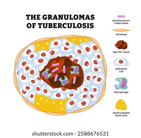 The Granulomas of Tuberculosis structure anatomy diagram medical poster, labeled mycobacterium tuberculosis, fibroblast, necrotic tissue, epithelioid cell, macrophage, multinucleated giant cell