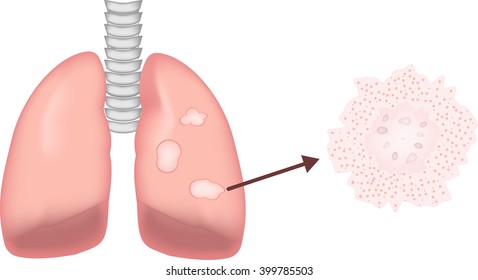 Granulomatous Lung Disease