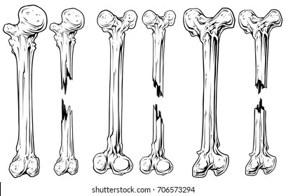 Graphic Black And White Different Broken Human Bone Vector Set. Vol. 3