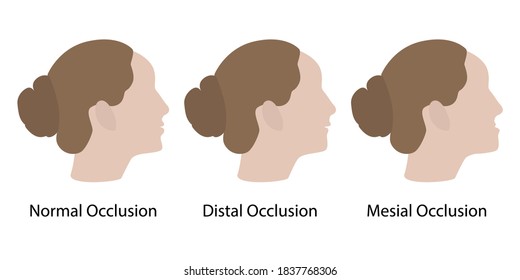  graphic display of mesial and distal malocclusion. Vector illustration