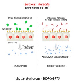 Graves' disease. autoimmune disorder. toxic diffuse goiter and cell of healthy thyroid gland. explanation about Abnormally high production hormones of thyroid gland (T3 and T4).