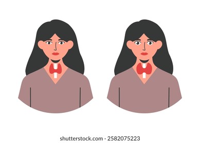 Graves disease illustration showing a woman with bulging eyes and enlarged thyroid compared to normal. Represents hyperthyroidism, hormonal imbalance, and autoimmune disorder. Vector illustration.