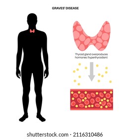 Cartel médico de la enfermedad de Graves. Trastornos del sistema inmunológico e hipertiroidismo. Glándula tiroidea hiperactiva. Enfermedades autoinmunes, síntomas, dolor e incomodidad en la ilustración vectorial plana del cuerpo humano