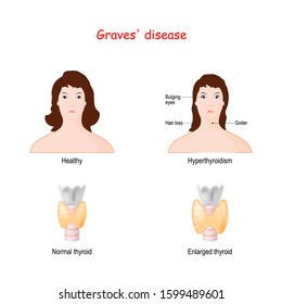 Graves disease. toxic diffuse goiter. autoimmune disease that affects the thyroid gland. Two Faces of adult females. Healthy woman and face with  labeled symptoms of hyperthyroidism