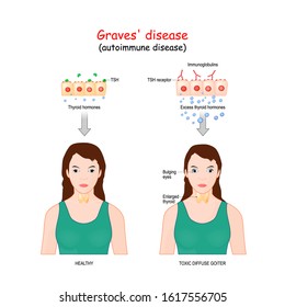 Graves' disease. toxic diffuse goiter is an autoimmune disease that affects the thyroid. Healthy female, and woman with symptoms of illness: Enlarged Thyroid, Bulging Eyes, immunoglobulins