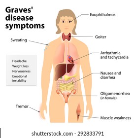 Myxedema High Res Stock Images Shutterstock Myxedema High Res Stock Images Shutterstock