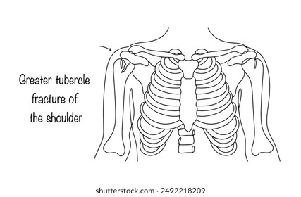 Fractura de tubérculo mayor del hombro. Daño a la protrusión de la parte superior del hueso, acompañado de una violación de la integridad del tejido. Ilustración vectorial.